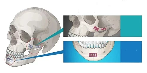 When is the best time to take out the titanium plate and titanium nail after operation When is the best time to take out the titanium plate and titanium nail after operation